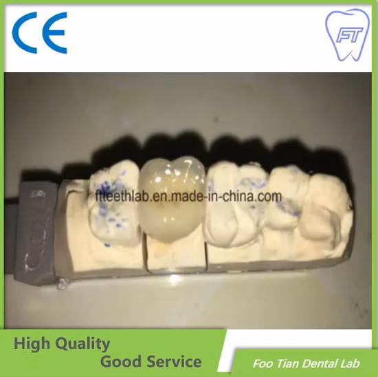 Dental Treatment Dental Metal Ceramic Crown Made in Foo Tian Dental Lab in Shenzhen China