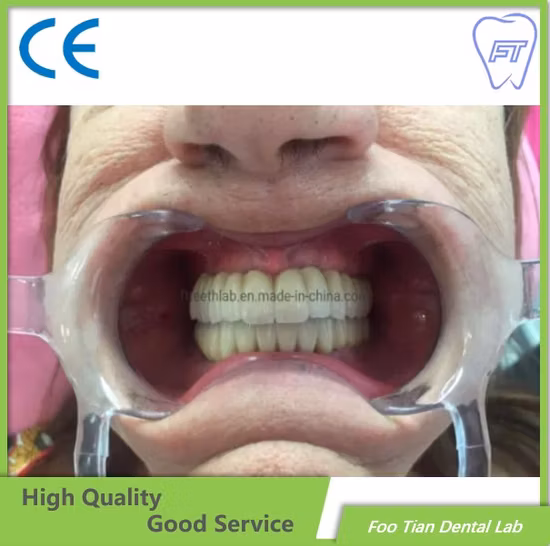 Dental Treatment Dental Metal Ceramic Crown Made in Foo Tian Dental Lab in Shenzhen China