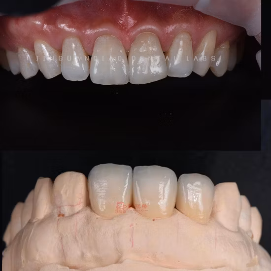 Corone in zirconio digitale Corone in zirconio stratificato Cina Dental Lab