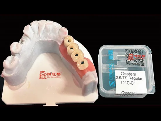 Laboratorio di materiali dentali Impianto di laboratorio dentale Protesi telescopica personalizzata
