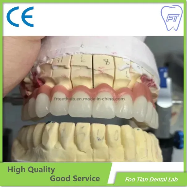 Corona in ceramica metallica dentale di marca Foo Tian prodotta nel laboratorio dentale Foo Tian a Shenzhen in Cina