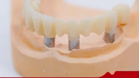 Stampa 3D in odontoiatria per corone su impianti
