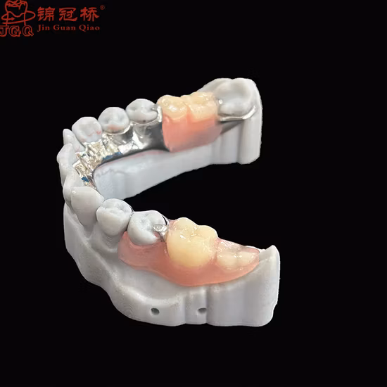 Protesi con struttura metallica rimovibile di alta qualità